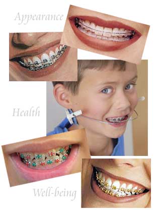 Braces straighten teeth by putting steady pressure on your teeth and by 
